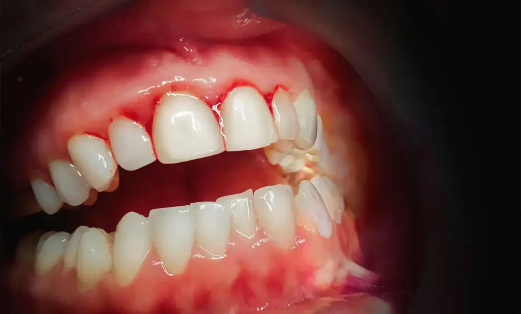 Tannkjøttbetennelse, gingivitt, sår i tannkjøttet